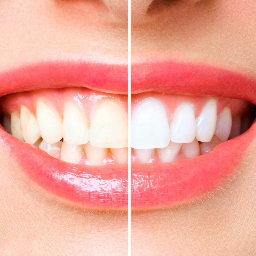 Clareamento Dental