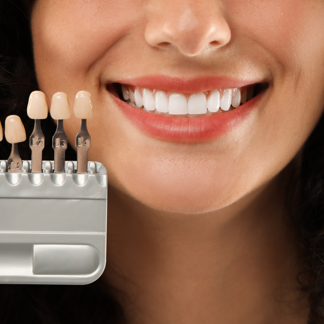 Lentes de Contato Dental